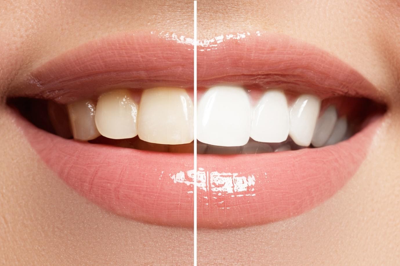 4 Tips For Finding The Best Dentist Who Whitens Teeth