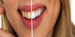 All You Need To Know About Teeth Whitening Procedures