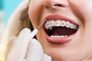 Types of Dental Braces Common Mistakes with Braces Care