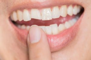 What Do You Do When You Have a Chipped Tooth